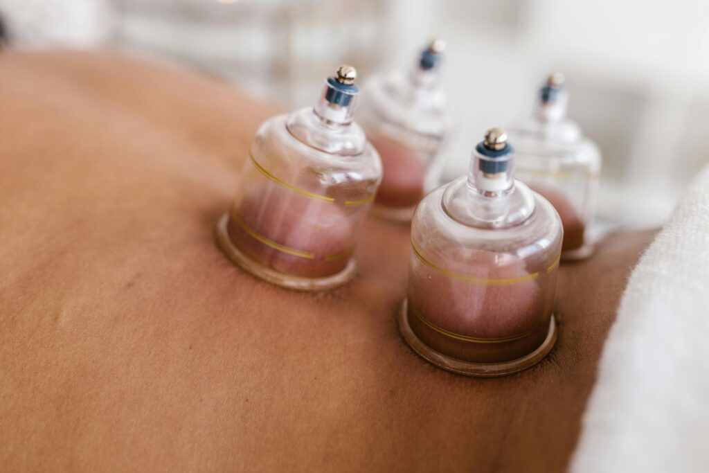 Cupping therapy 